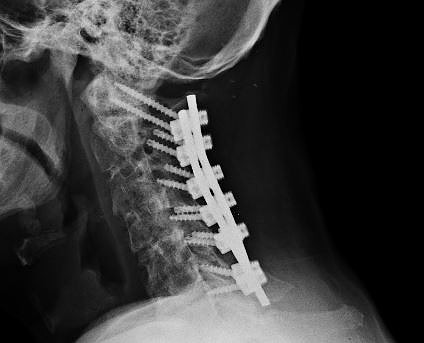 Neck - 12 27 2016
